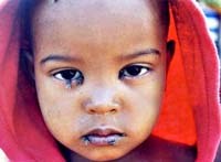 Bệnh mắt hột do vi khuẩn Chlamydia trachomatis-một trong những căn bệnh bị lãng quên đang được thế giới quan tâm