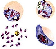 Nhân trường hợp chậm cắt ký sinh trùng sốt rét trên bệnh nhân sốt rét P. falciparum  đã cắt lách