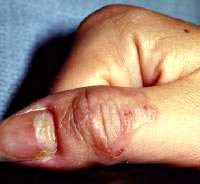 Phát hiện và xử trí hội chứng ban trườn hoặc hội chứng ấu trùng di chuyển dưới da do ký sinh trùng  (Creeping Eruption Syndrome hoặc Cutaneous larva migrans Syndrome)