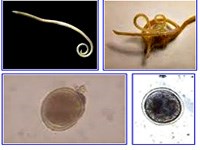 Những ca bệnh ký sinh trùng đặc biệt ở người