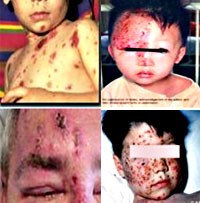 Bệnh thủy đậu, Zona và chốc lây-Dấu chứng, triệu chứng, biến chứng và thái độ xử trí