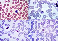 Tại sao phải dùng dung dịch đệm pH 7,2 để pha giemsa nhuộm lam máu ?