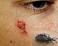 Đừng hoang mang trước bọ xít hút máu người