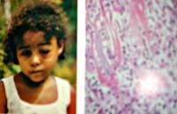 Bệnh do Trypanosoma (Trypanosomiasis)