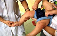 Tổng hợp một số ca bệnh nhi đặc biệt mắc sốt Dengue và sốt xuất huyết Dengue đã được cứu sống tại các bệnh viện tại Việt Nam