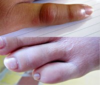 Tiếp tục thu thập thông tin về bọ xít hút máu tại Huế