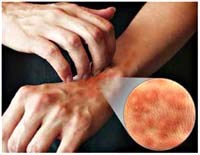 Một số xét nghiệm chuyên khoa dị ứng góp phần tầm soát và phát hiện bệnh ký sinh trùng thấu đáo hơn