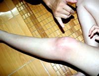 Cập nhật thông tin về bọt xít hút máu tại Việt Nam