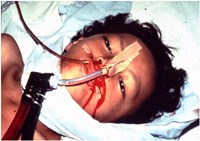 Những kinh nghiệm lâm sàng rút ra từ 3 ca bệnh sốt xuất huyết đặc biệt được cấp cứu thành công