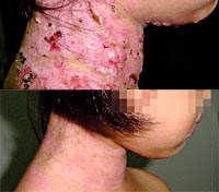 Chẩn đoán phân biệt những ca bệnh về da hiếm gặp với bệnh lý do ký sinh trùng