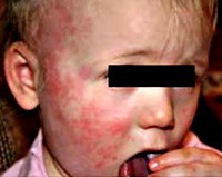 Phản ứng Herxheimer trong chẩn đoán và điều trị bệnh ký sinh trùng