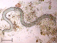 Ca bệnh đặc biệt do tắc tá tràng-một biến chứng viêm ruột không thường gặp do giun lươn Strongyloides stercoralis