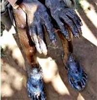 Uganda: Bệnh hoại tử da kinh hoàng do côn trùng