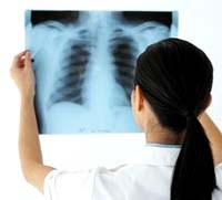 Trị lao bằng phương pháp DOTS là gì ?