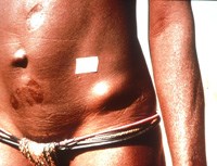 Độ nhạy và độ đặc hiệu trong thử nghiệm huyết thanh chẩn đoán bệnh giun sán ở người