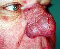 Không nên nhầm lẫn mụn trứng cá với các biểu hiện của bệnh ký sinh trùng