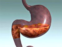 Bệnh lỵ a míp ngoài đại tràng