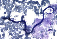 Loa Loa gây bệnh gì ?