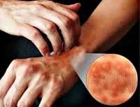 Tương tác giữa nhiễm trùng và mày đay mãn tính (Interactions of Infectious Diseases and Chronic urticaria)