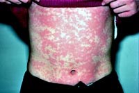 Một số hình thái lâm sàng thường gặp trong dị ứng thuốc hoặc hóa chất