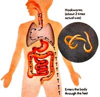 Làm thế nào để điều trị bệnh giun sán có hiệu quả ?