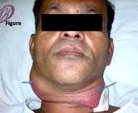 Cảnh báo bệnh Melioidosis xuất hiện