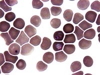 Có phải sốt rét dai dẳng không thể chữa khỏi ?