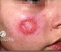 Muỗi cát (Phlebotomus) truyền bệnh gì ?