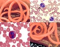 Bàn luận ca bệnh có thói quen ăn đất (geophagia) nhân trường hợp tăng bạch cầu ái toan không rõ nguyên nhân