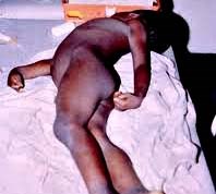 Cập nhật thông tin về một số điểm mới trong lâm sàng sốt rét ác tính T