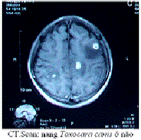 Một số thuốc phối hợp và hỗ trợ điều trị bệnh ký sinh trùng ở hệ thần kinh trung ương