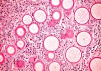 U sùi ở mặt do nấm