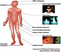 Sự khác biệt giữa bệnh Melioidosis ở người & bệnh Glander nhiễm trùng thú y
