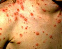 Điểm báo về các thông tin liên quan đến y tế ngày 19, 20 & 21 tháng 2 năm 2011