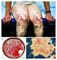 Tổng hợp y văn và cập nhật thông tin lâm sàng về hai trường hợp bệnh Melioidosis tại Việt Nam