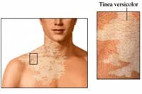 Vi nấm gây bệnh ở người có phải là những căn bệnh đang bị lãng quên ?