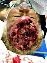 Giun sán gây ra những tác hại gì ?