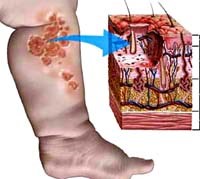 Một số hình thái lâm sàng viêm da thường gặp ở trẻ em dễ chẩn đoán nhầm với các bệnh do ký sinh trùng