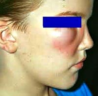 Bệnh giun mới nổi-Cập nhật y văn thế giới về 12 ca bệnh đặc biệt về giun đầu gai Gnathostoma spp. ở người