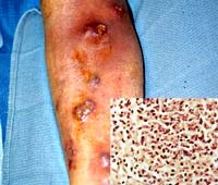 Cần cảnh giác với bệnh truyền nhiễm nguy hiểm do Nocardia spp. 