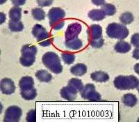 Báo cáo một trường hợp nhiễm P.ovale tại Bình Thuận, miền Trung Việt Nam