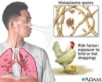 Cần quan tâm đến bệnh nhiễm nấm phổi