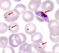 Ký sinh trùng sốt rét Plasmodium falciparum kháng thuốc artesunate:Chưa phát hiện tại Bình Định 