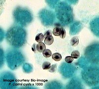 Viêm phổi do nhiễm trùng bào tử Pneumocystis carinii