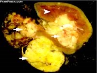 Cập nhật y văn thế giới nhân một trường hợp u hỗn hợp Angiomyolipoma trên thận phát hiện tại Viện Sốt rét-KST-CT Quy Nhơn (Renal Angiomyolipoma case in women in IMPE Quy Nhon: Medical literrature Reviews) 