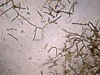 Một trường hợp áp xe não do nhiễm hai loại nấm Candida albicans và Cladosporium batiana tại Bệnh viện Trường Đại học Y Dược Huế 