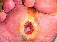 Các dấu hiệu nguy hiểm của bệnh tiểu đường cần tới cơ sở y tế