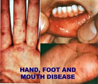 Bệnh tay chân miệng bùng phát với nhiều biến chứng nghiêm trọng và nguy cơ tử vong cao