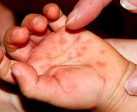 Bệnh tay-chân-miệng tiếp tục gây tử vong và những thách thức từ chủng vius mới xuất hiện Enterovirus 71