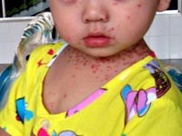 Hiểu biết và phòng tránh bệnh tay-chân-miệng (Hand, foot and Mouth Diseases)  